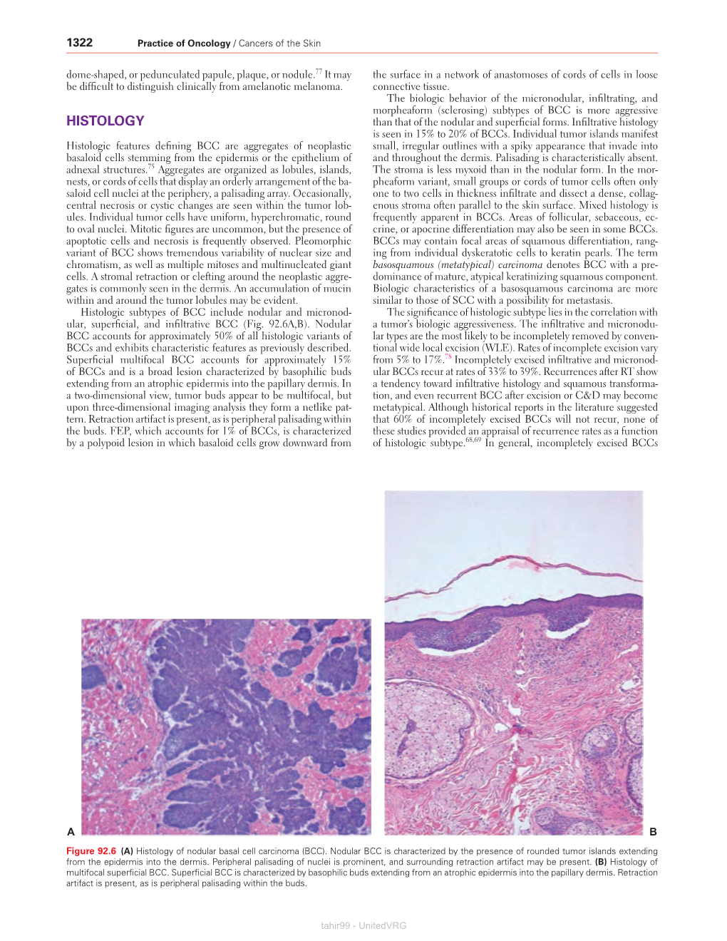 HISTOLOGY Than That of the Nodular and Superficial Forms