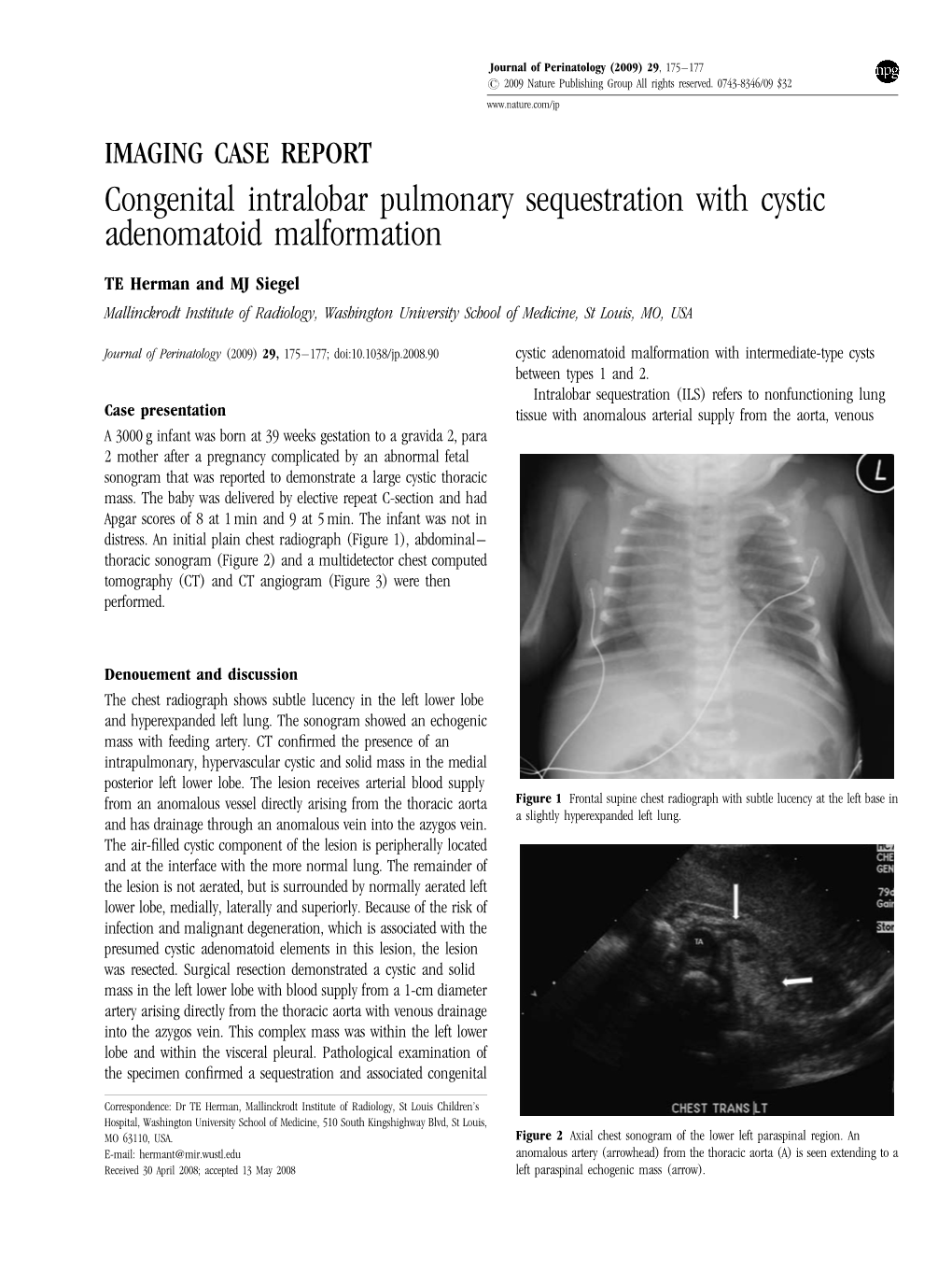 Congenital Intralobar Pulmonary Sequestration with Cystic Adenomatoid Malformation