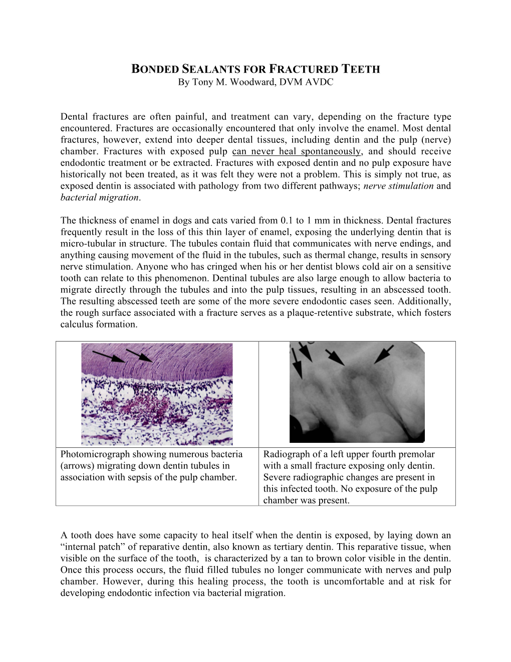 BONDED SEALANTS for FRACTURED TEETH by Tony M