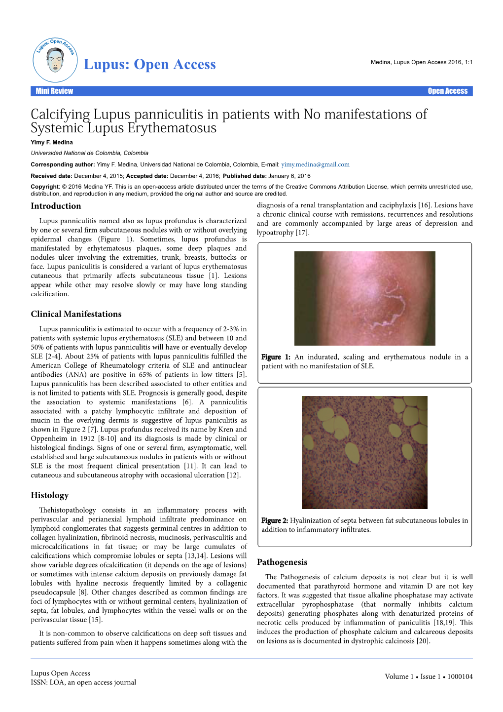 Calcifying Lupus Panniculitis in Patients with No Manifestations of Systemic Lupus Erythematosus Yimy F