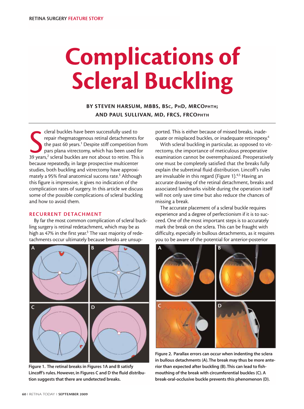 Complications of Scleral Buckling