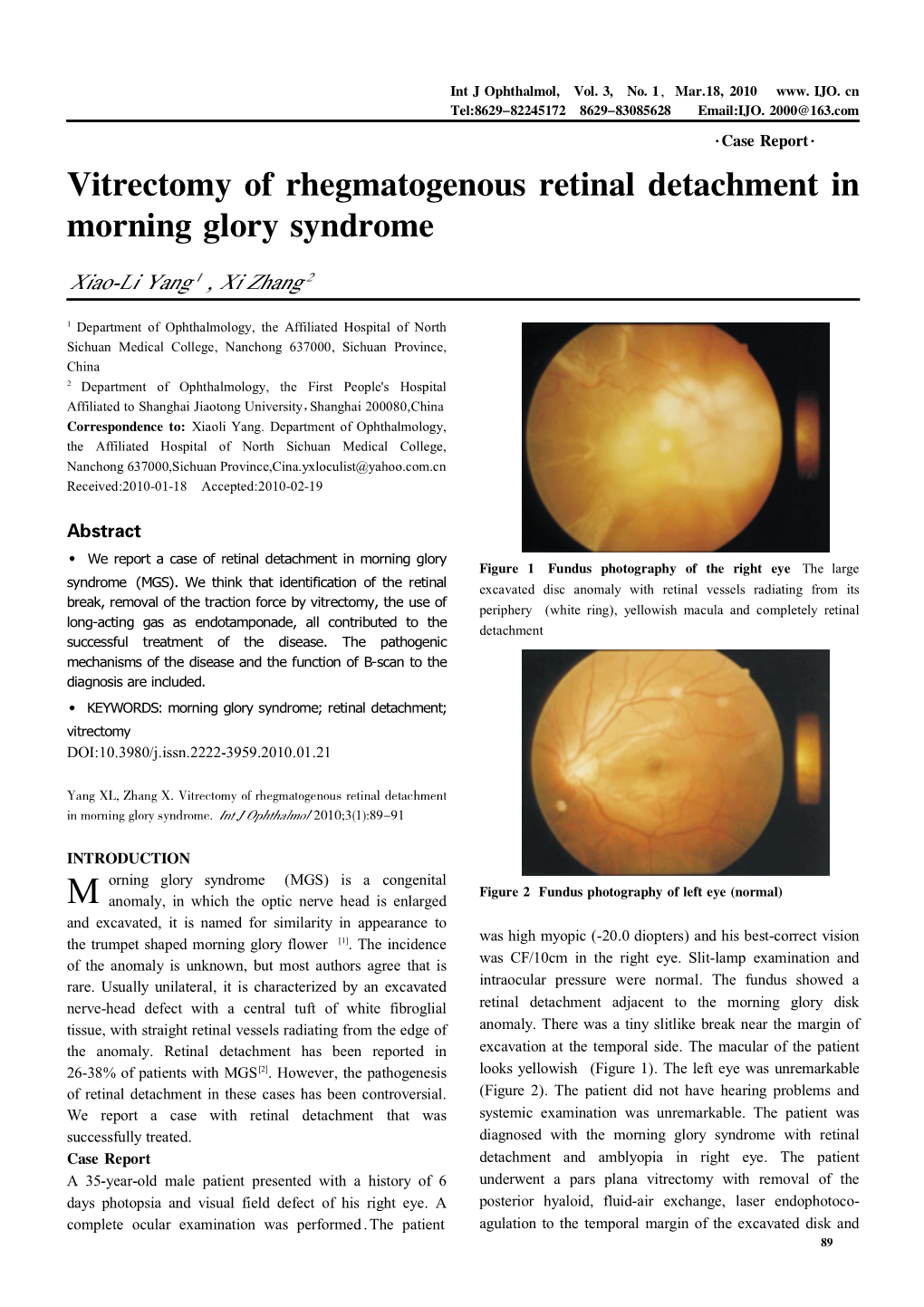 Vitrectomy of Rhegmatogenous Retinal Detachment in Morning Glory