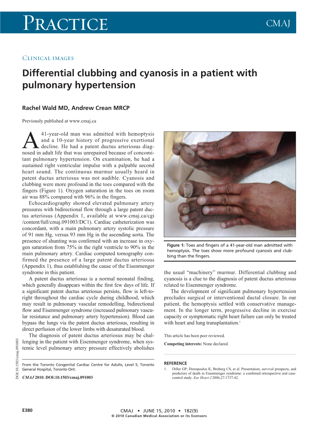 Differential Clubbing and Cyanosis in a Patient with Pulmonary Hypertension
