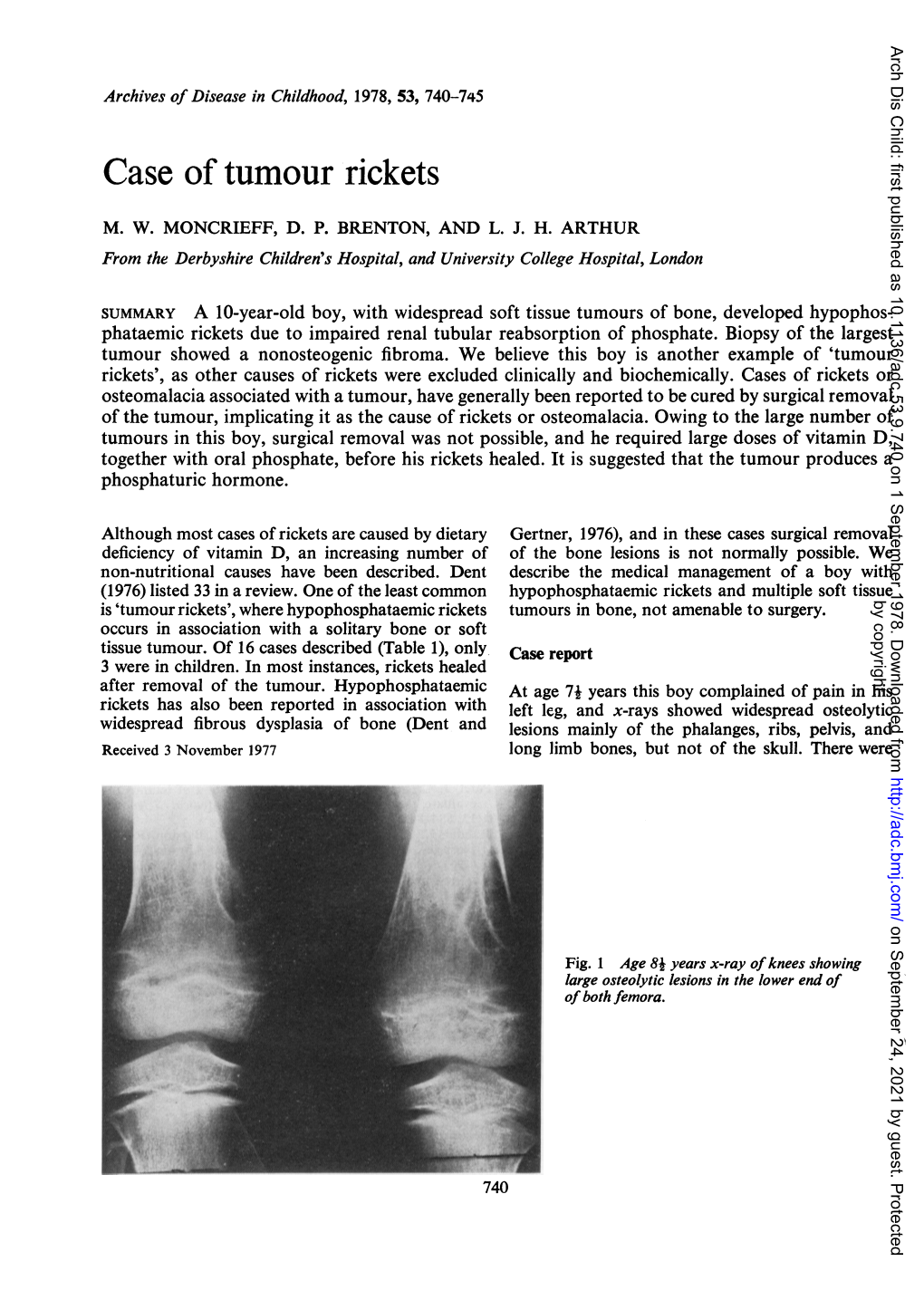 Case Oftumour Rickets