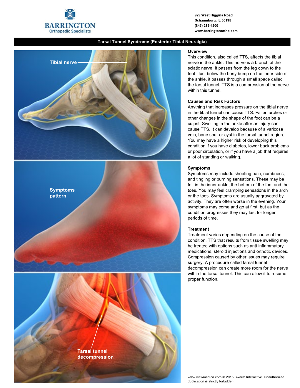 Tibial Nerve Symptoms Pattern Tarsal Tunnel Decompression