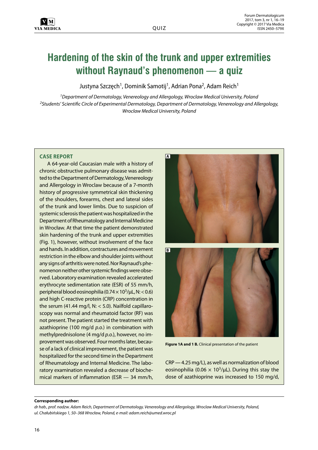 Hardening of the Skin of the Trunk and Upper Extremities Without