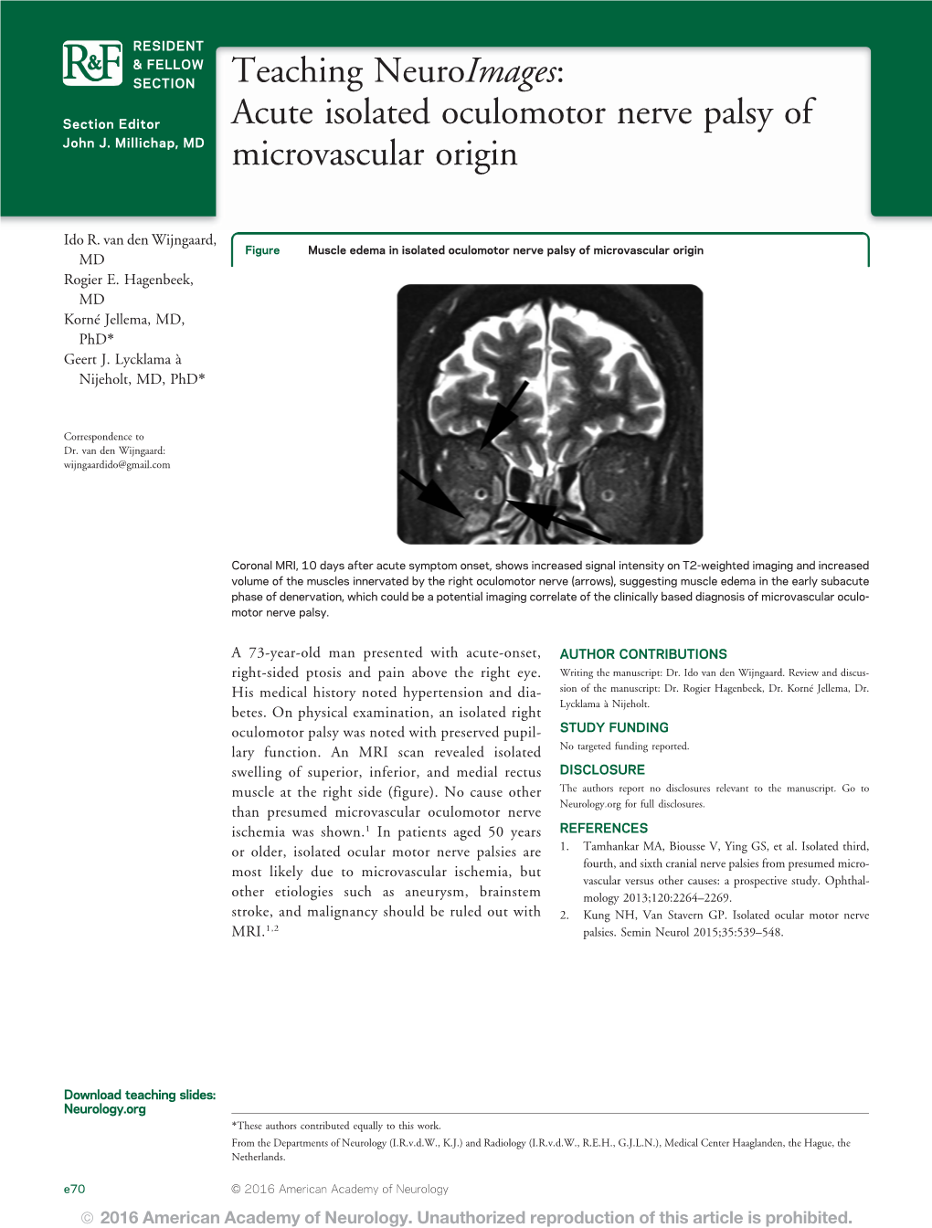 Acute Isolated Oculomotor Nerve Palsy of Microvascular Origin Ido R