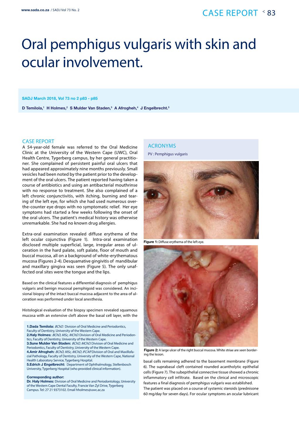 Oral Pemphigus Vulgaris with Skin and Ocular Involvement