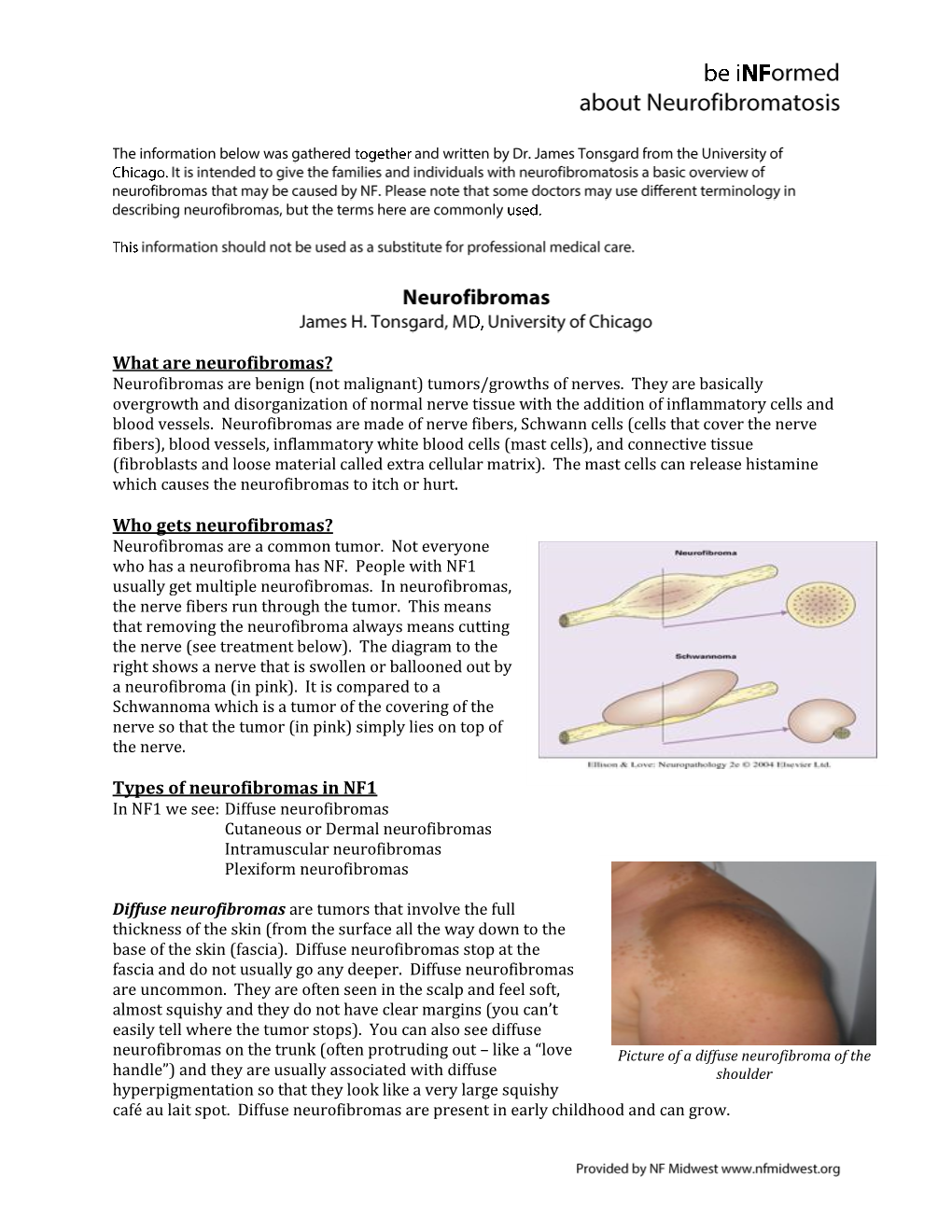 What Are Neurofibromas? Neurofibromas Are Benign (Not Malignant) Tumors/Growths of Nerves