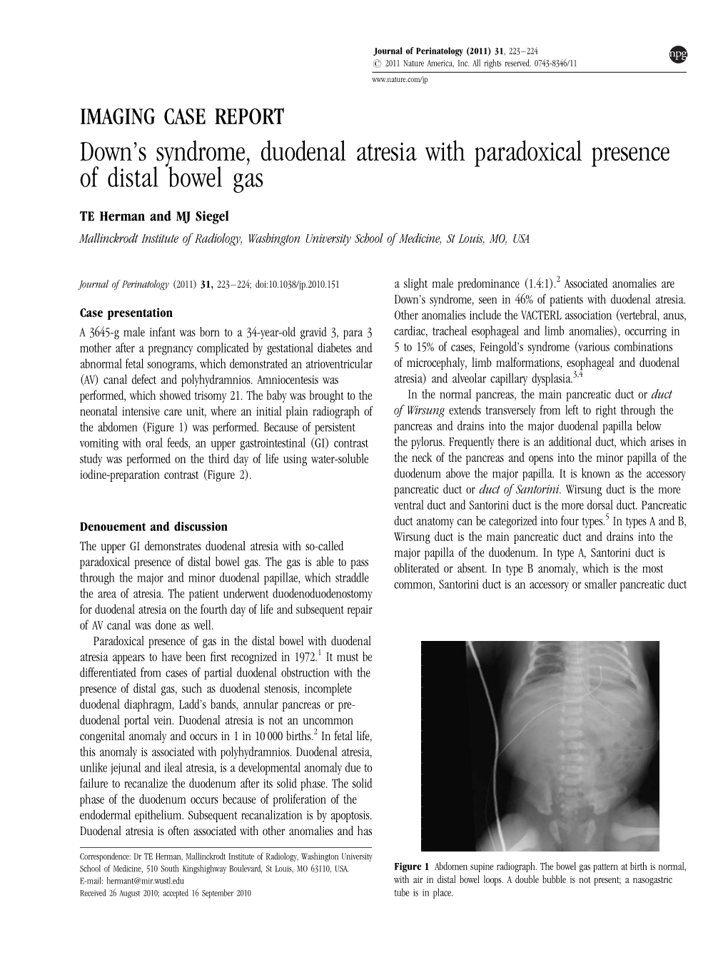 S Syndrome, Duodenal Atresia with Paradoxical Presence of Distal Bowel Gas