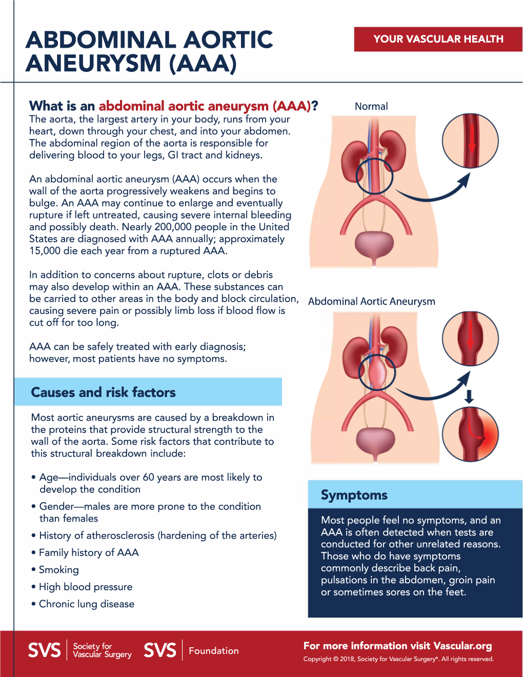 Abdominal Aortic Aneurysm (Aaa)