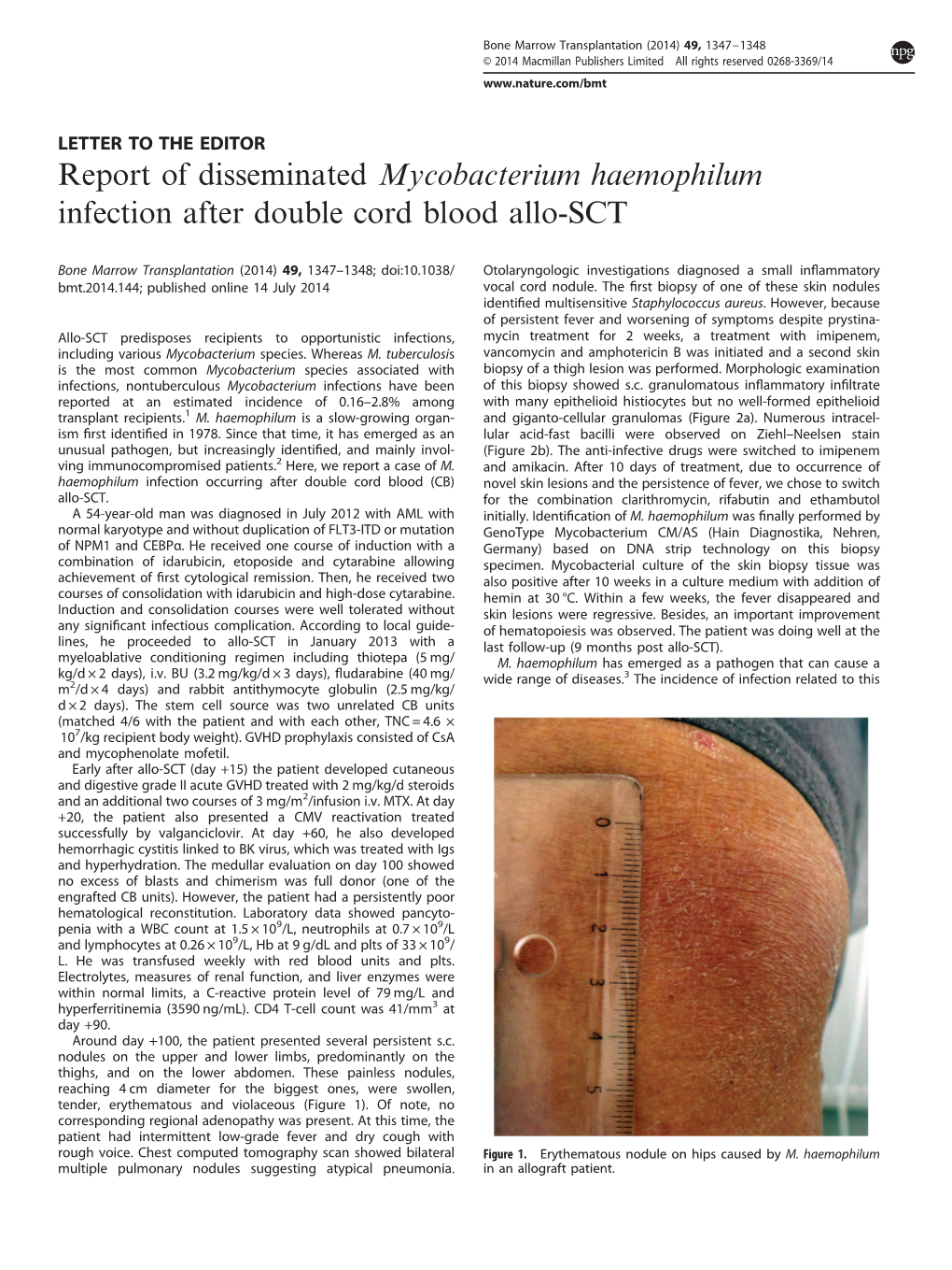 Report of Disseminated Mycobacterium Haemophilum Infection After Double Cord Blood Allo-SCT