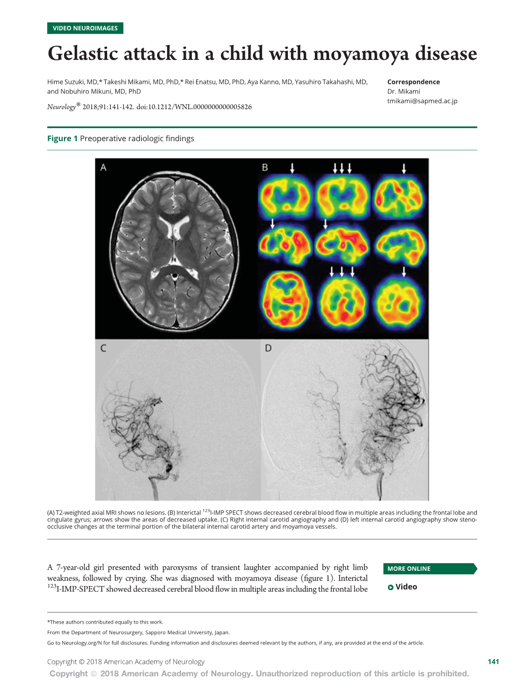 Gelastic Attack in a Child with Moyamoya Disease