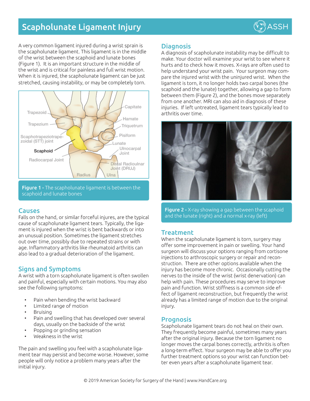 Scapholunate Ligament Injury