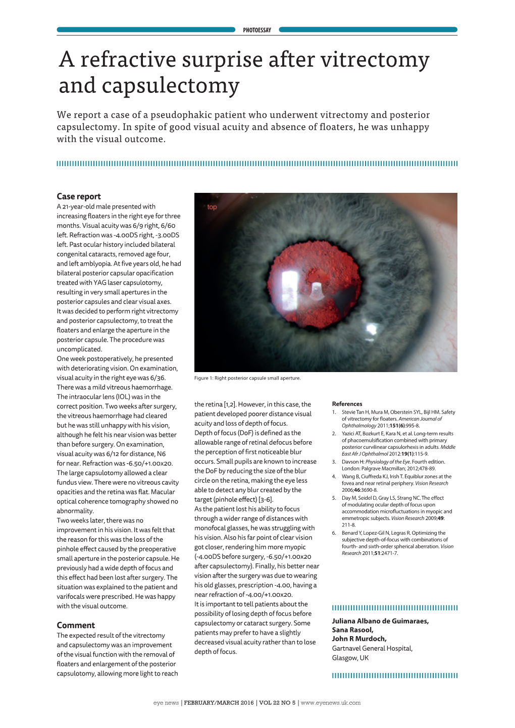 A Refractive Surprise After Vitrectomy and Capsulectomy