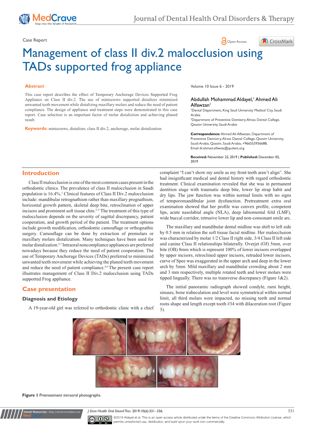 Management of Class II Div.2 Malocclusion Using Tads Supported Frog Appliance