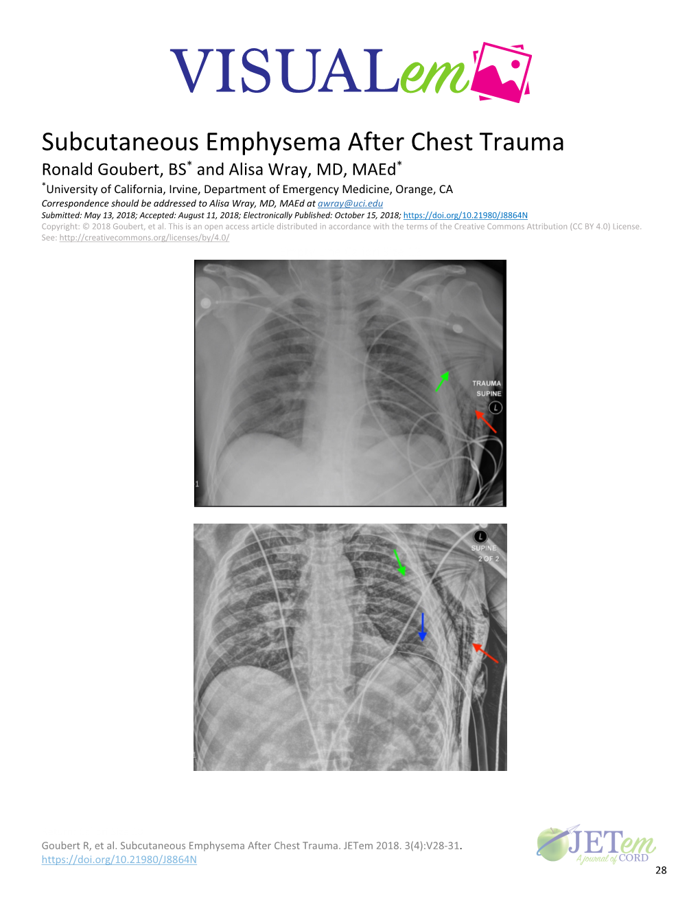 Subcutaneous Emphysema After Chest Trauma