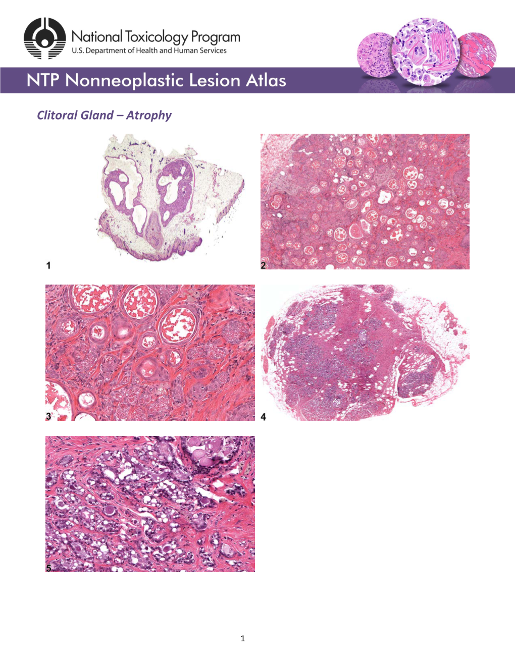 Clitoral Gland – Atrophy