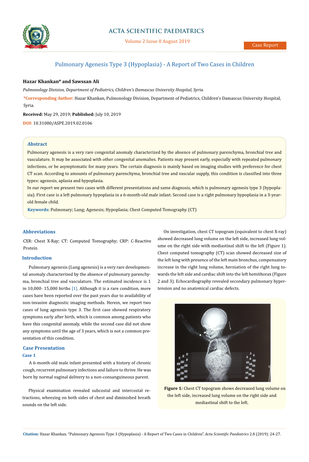 Pulmonary Agenesis Type 3 (Hypoplasia) - a Report of Two Cases in Children