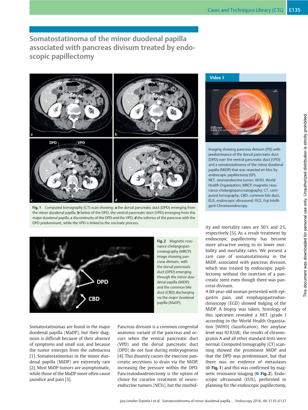 Somatostatinoma of the Minor Duodenal Papilla Associated with Pancreas Divisum Treated by Endo- Scopic Papillectomy