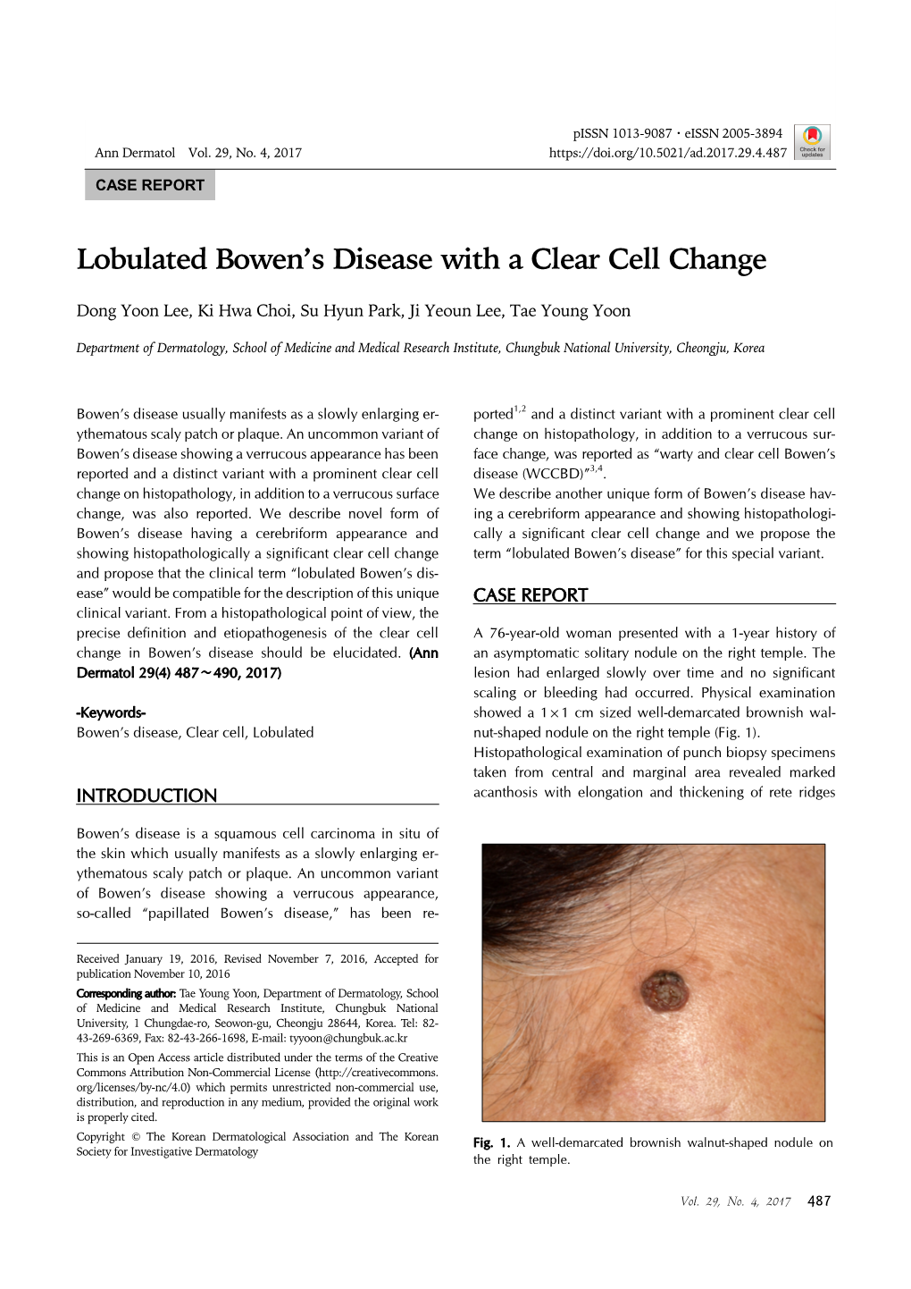 Lobulated Bowen's Disease with a Clear Cell Change