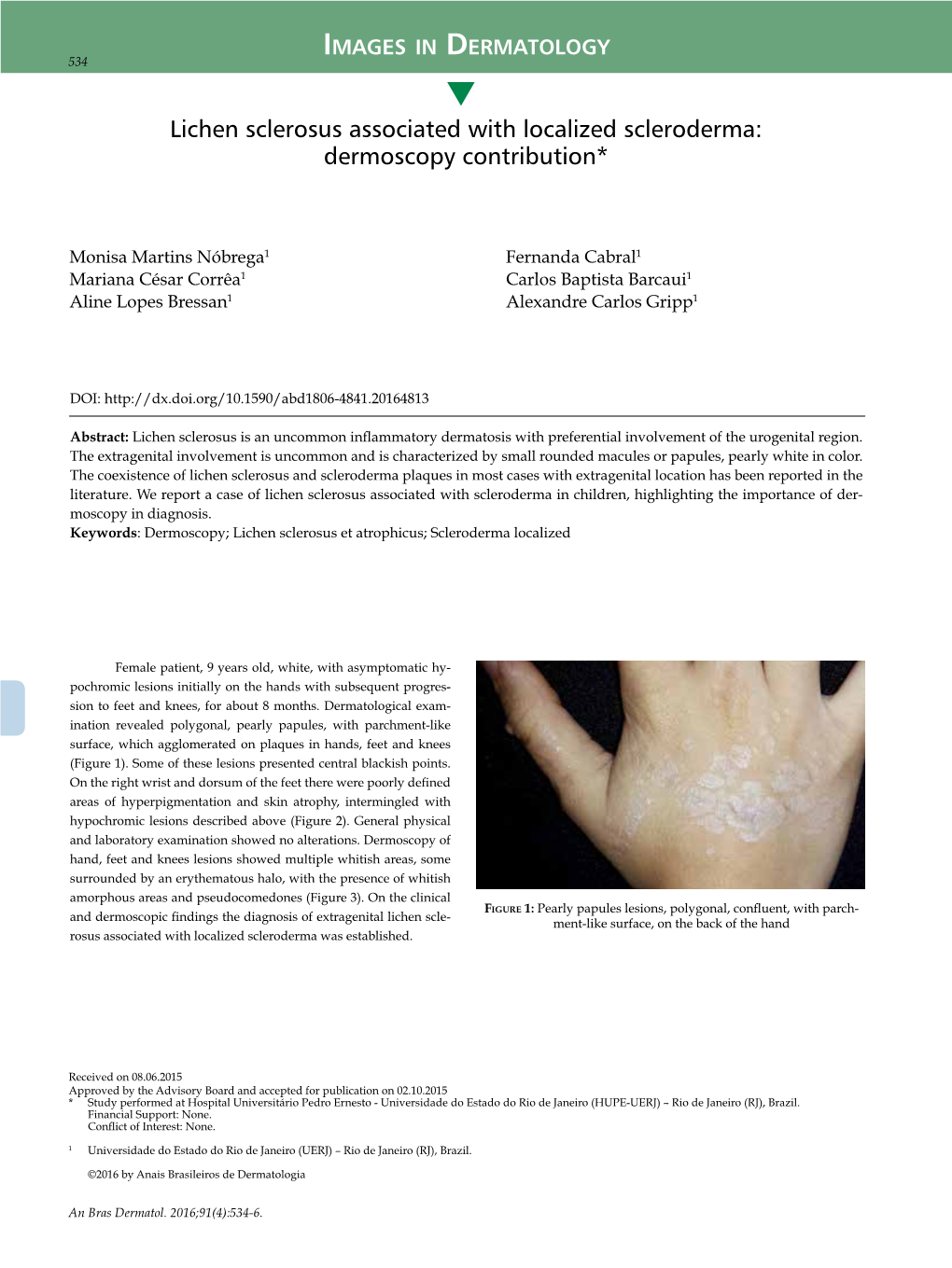 Lichen Sclerosus Associated with Localized Scleroderma: Dermoscopy Contribution*
