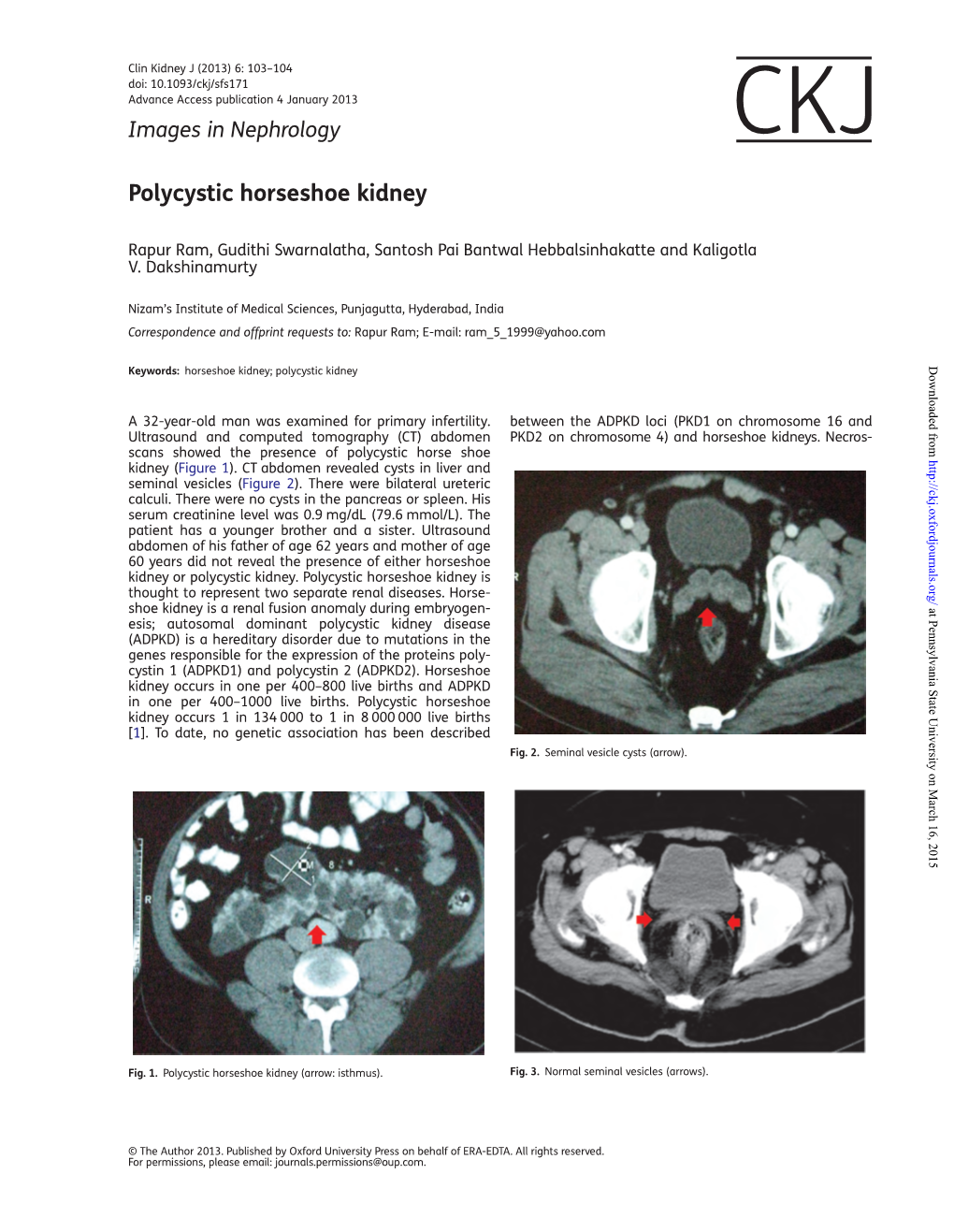 Polycystic Horseshoe Kidney