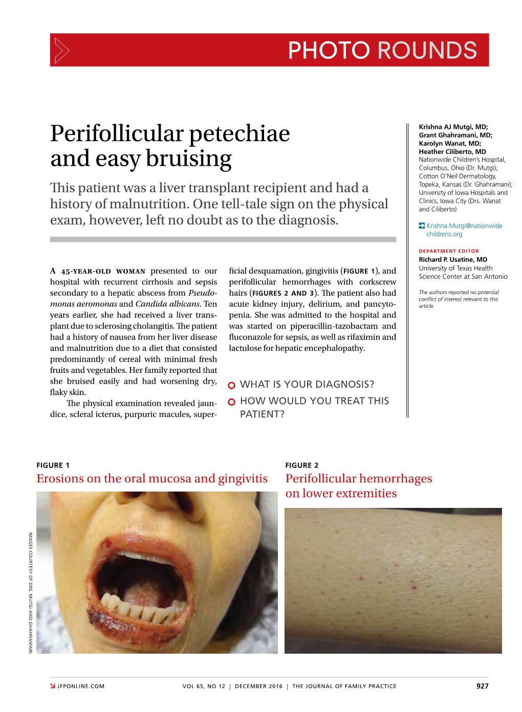 Perifollicular Petechiae and Easy Bruising