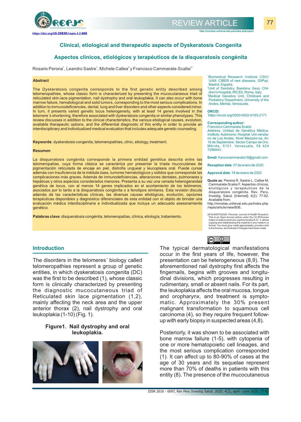 Clinical, Etiological and Therapeutic Aspects of Dyskeratosis Congenita Periodontal De Los Escolares De 7 a 12 Años Medicina De Familia.2015; 8(2): 110-118