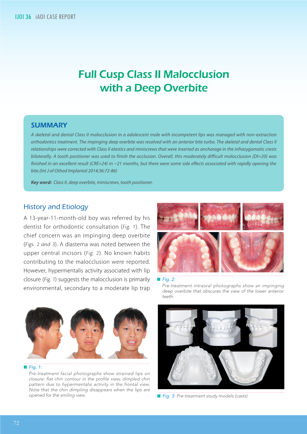 Full Cusp Class II Malocclusion with a Deep Overbite IJOI 36