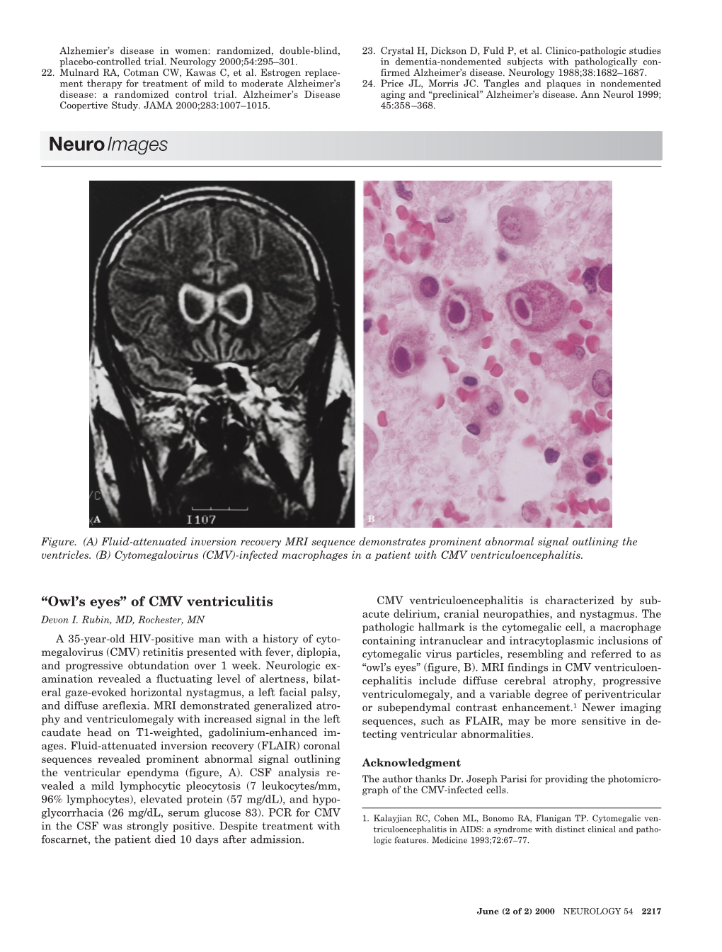 Of CMV Ventriculitis CMV Ventriculoencephalitis Is Characterized by Sub- Acute Delirium, Cranial Neuropathies, and Nystagmus