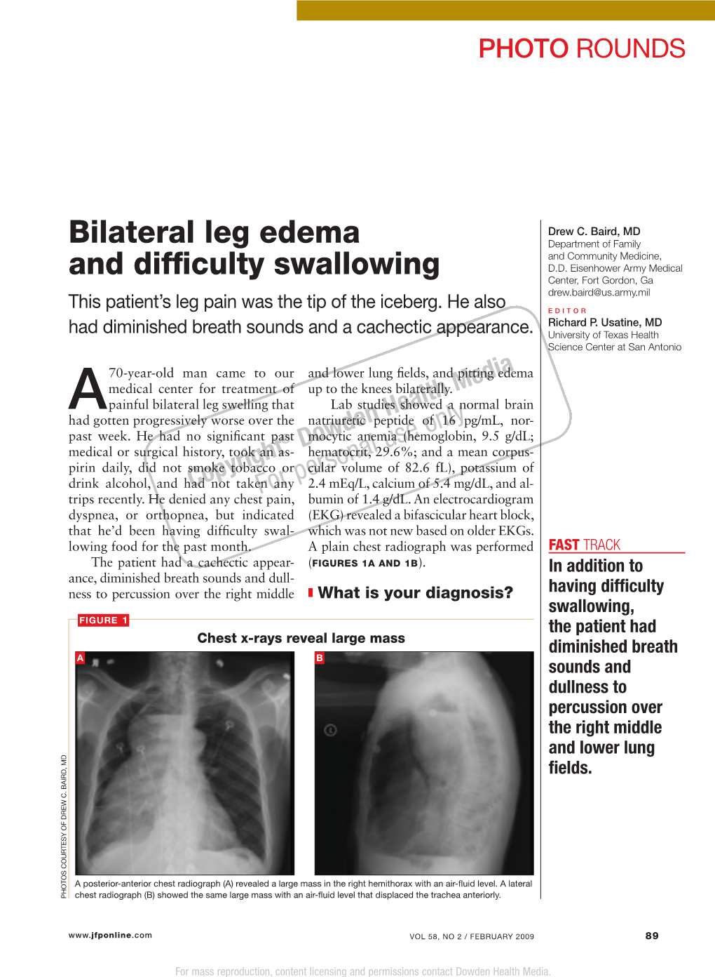 Bilateral Leg Edema and Difficulty Swallowing