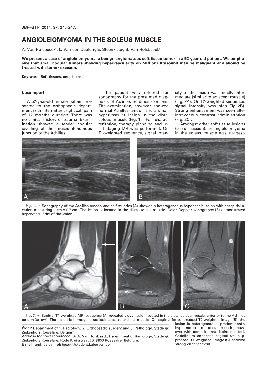 Angioleiomyoma in the Soleus Muscle