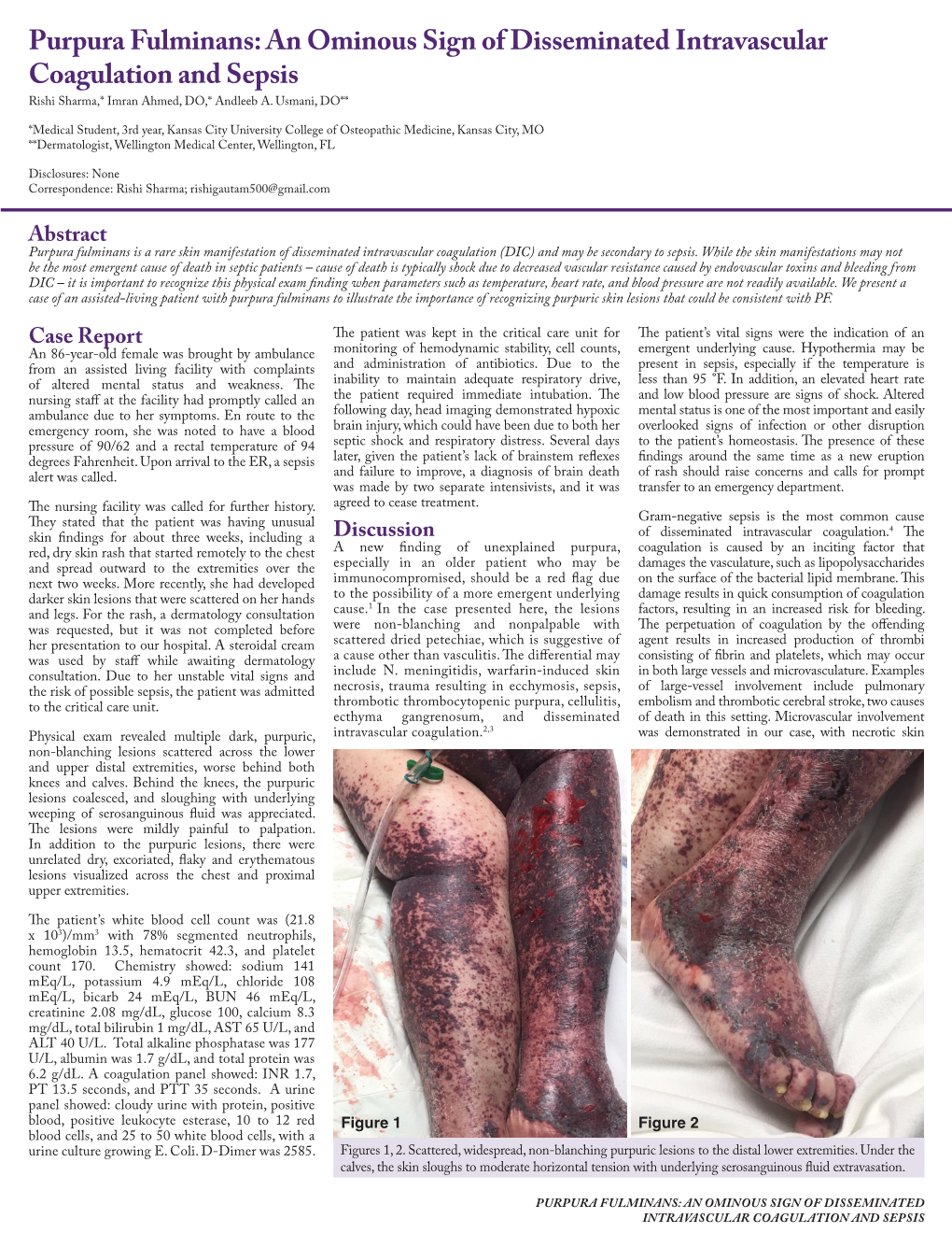 Purpura Fulminans: an Ominous Sign of Disseminated Intravascular Coagulation and Sepsis Rishi Sharma,* Imran Ahmed, DO,* Andleeb A