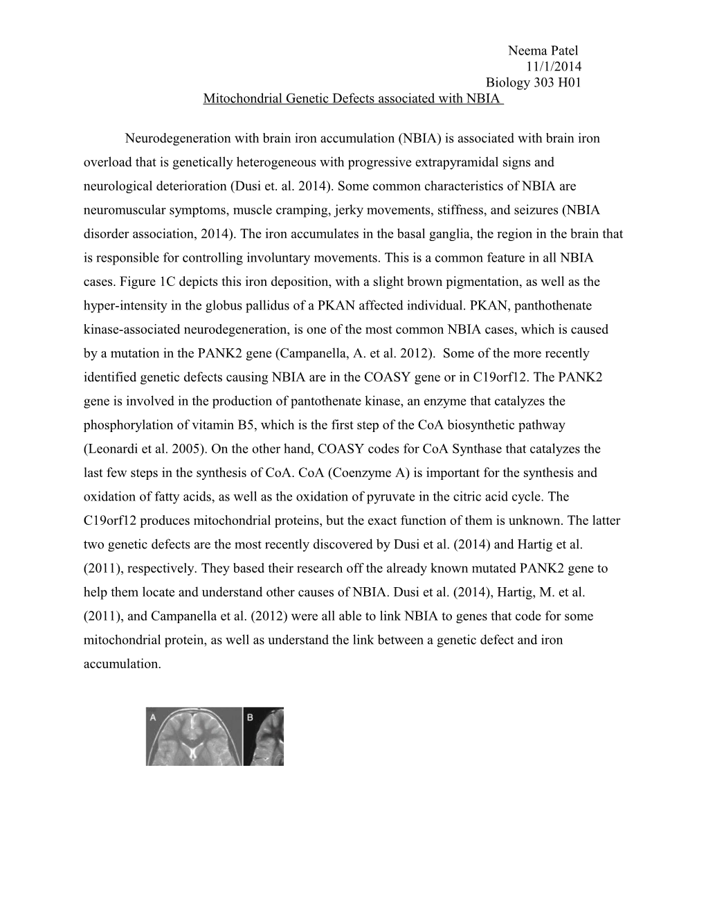 Mitochondrial Genetic Defects Associated with NBIA