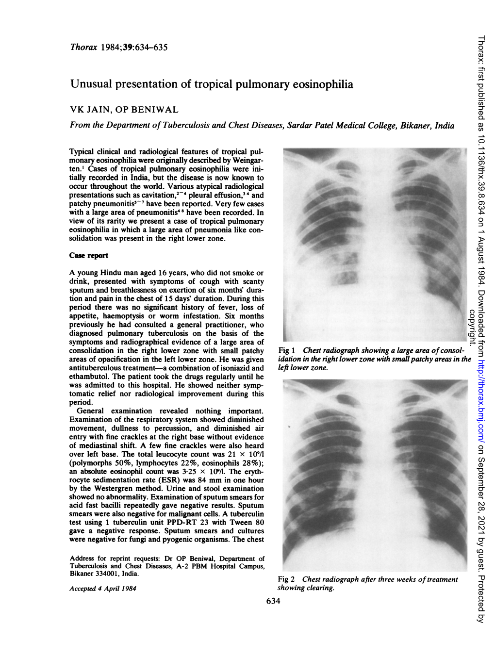 Unusual Presentation of Tropical Pulmonary Eosinophilia