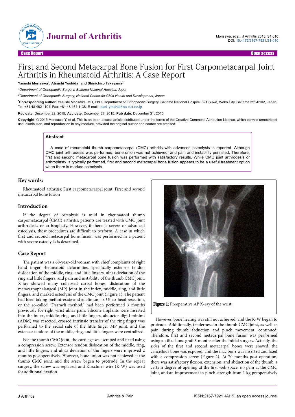 First and Second Metacarpal Bone Fusion for First Carpometacarpal Joint