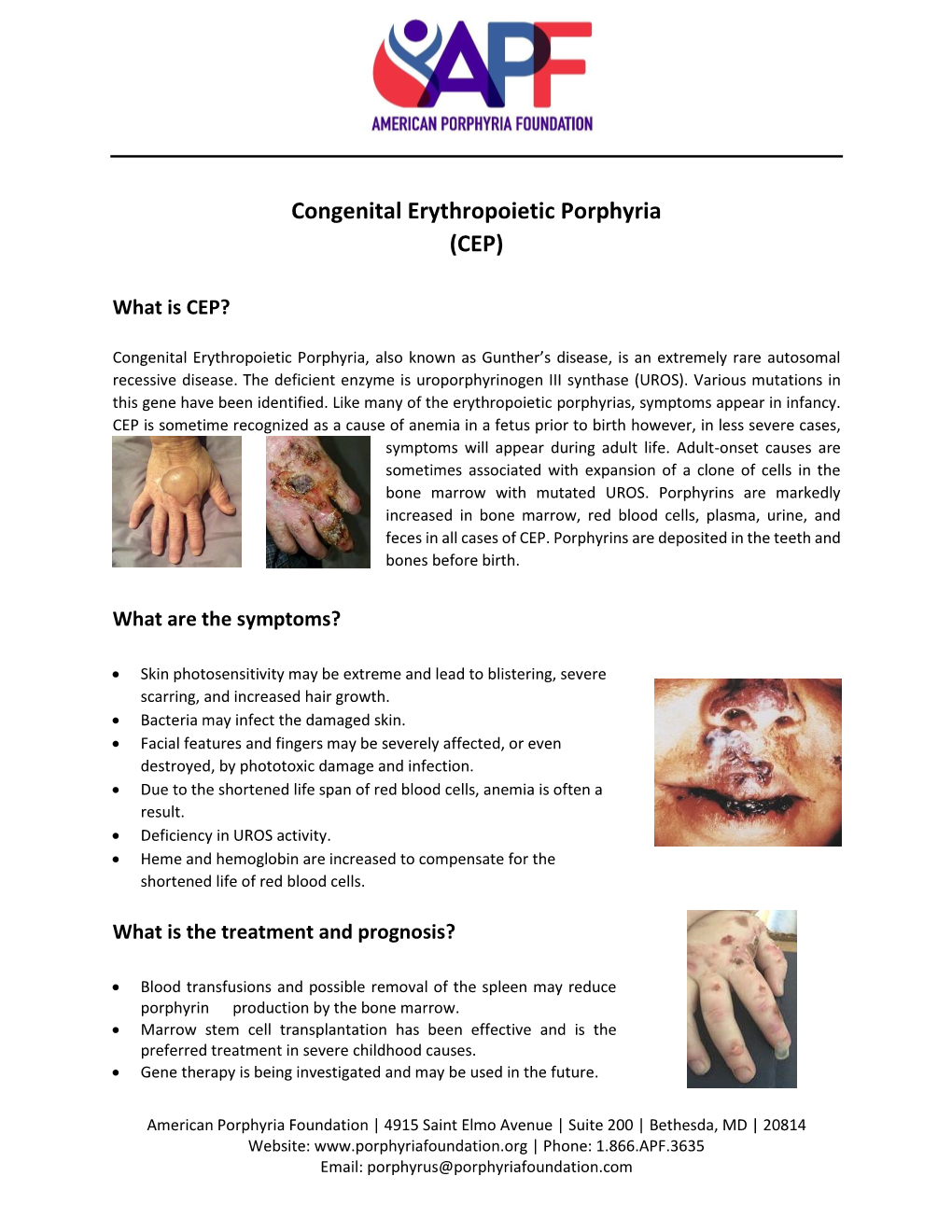 Congenital Erythropoietic Porphyria (CEP)