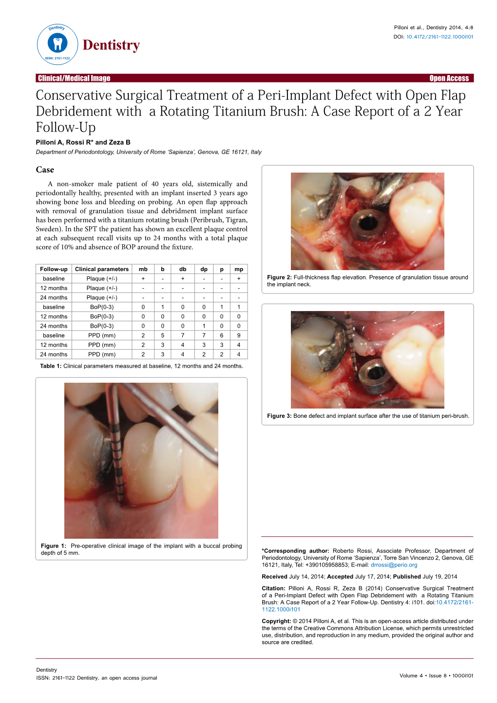 Conservative Surgical Treatment of a Peri-Implant Defect with Open Flap Debridement with a Rotating Titanium Brush: a Case Repor