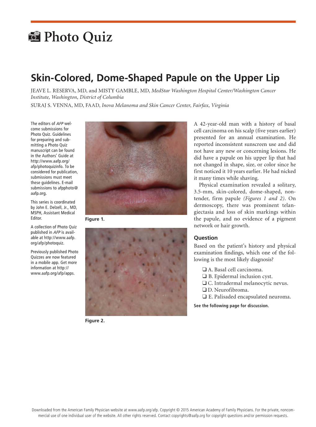 Skin-Colored, Dome-Shaped Papule on the Upper Lip JEAVE L