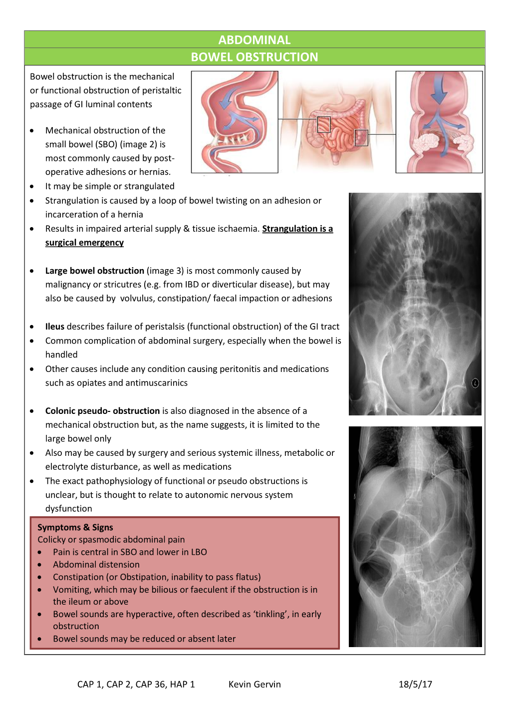 ABDOMINAL BOWEL OBSTRUCTION Bowel Obstruction Is the Mechanical Or Functional Obstruction of Peristaltic Passage of GI Luminal Contents