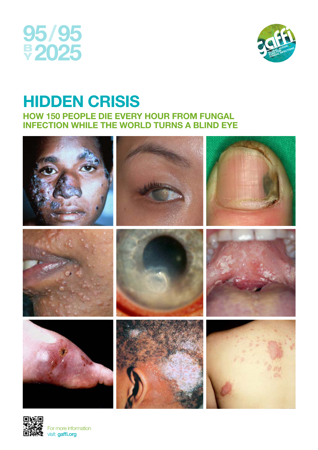 Hidden Crisis How 150 People Die Every Hour from Fungal Infection While the World Turns a Blind Eye