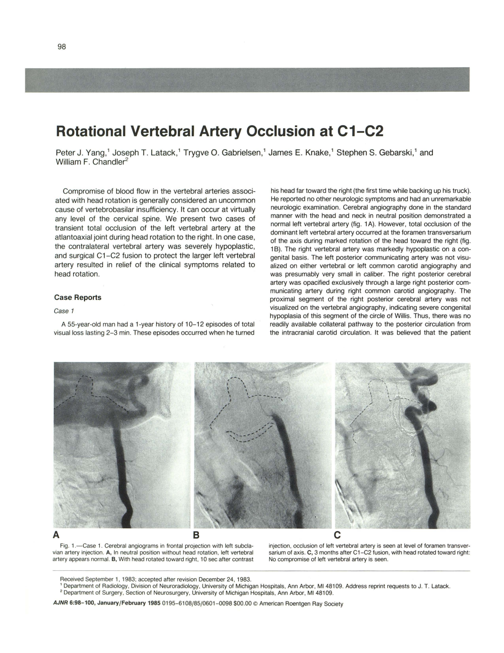 Rotational Vertebral Artery Occlusion at C1-C2