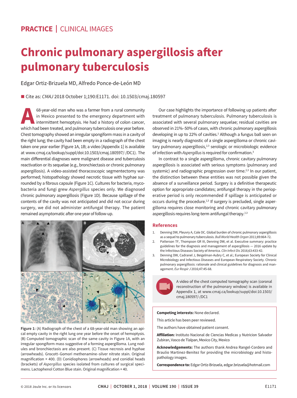 Chronic Pulmonary Aspergillosis After Pulmonary Tuberculosis