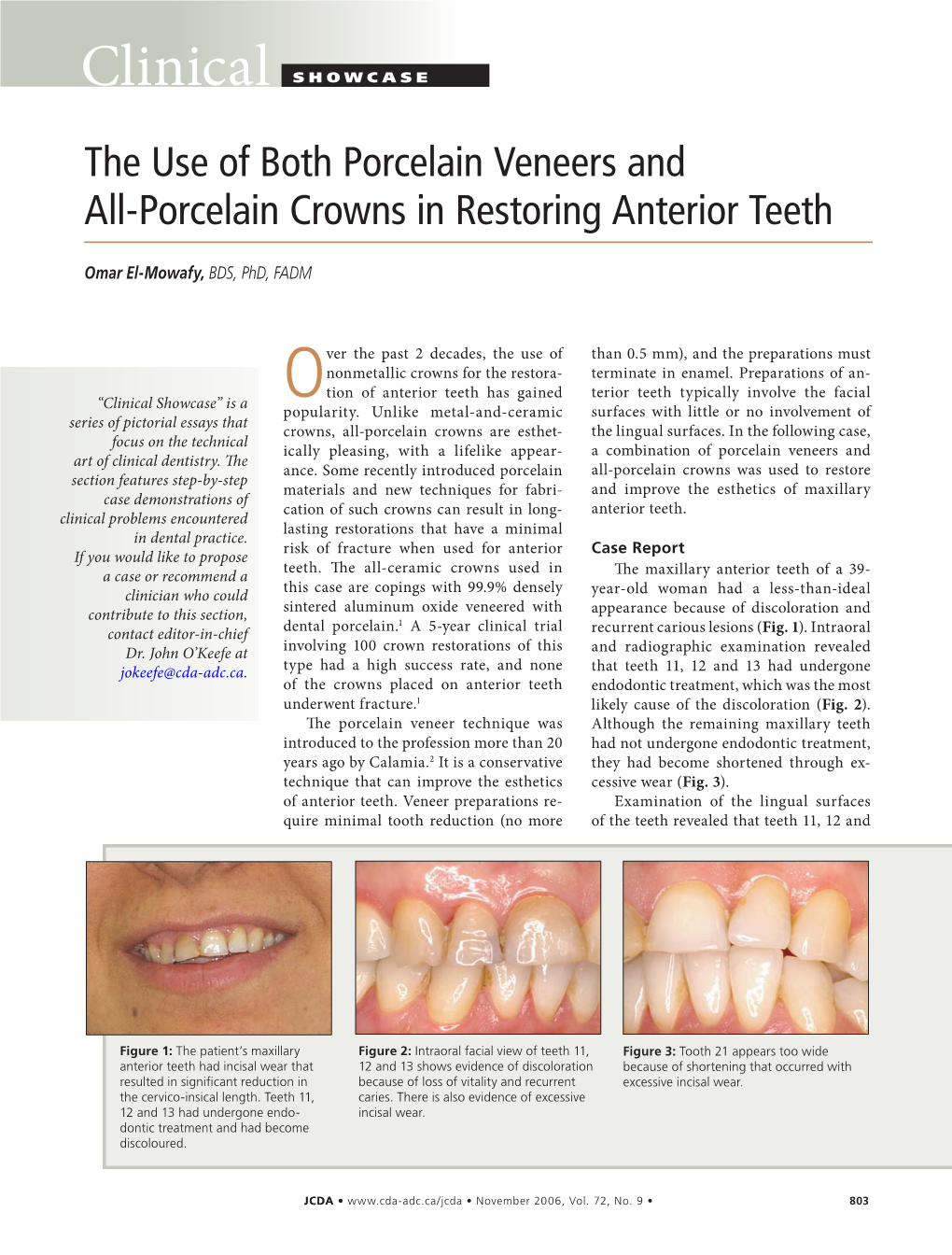 The Use of Both Porcelain Veneers and All-Porcelain Crowns in Restoring Anterior Teeth