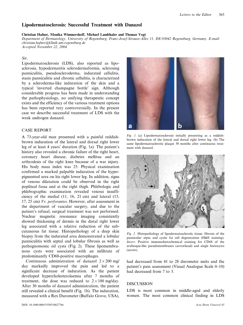 Lipodermatosclerosis: Successful Treatment with Danazol