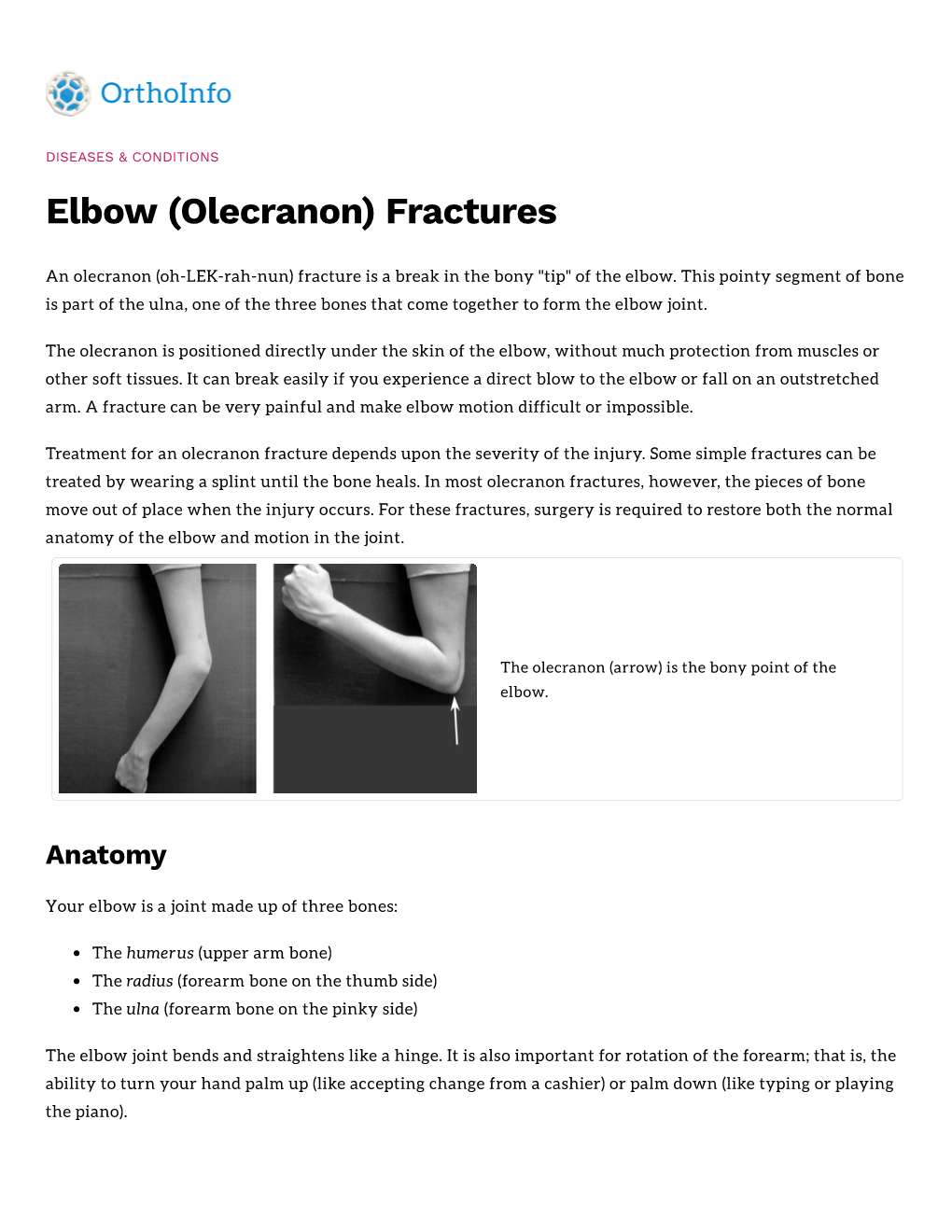 (Olecranon) Fractures