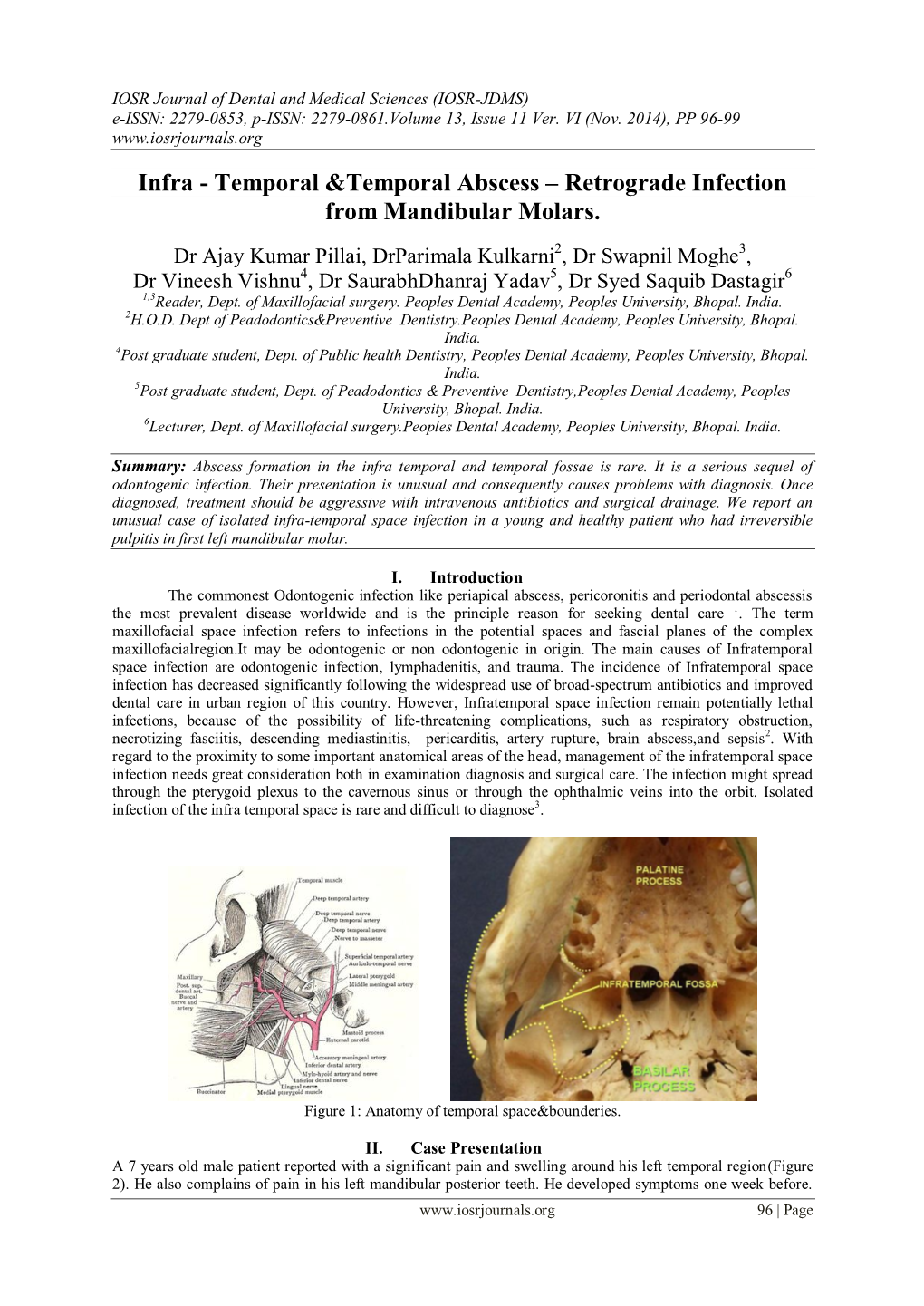 Infra - Temporal &Temporal Abscess – Retrograde Infection from Mandibular Molars