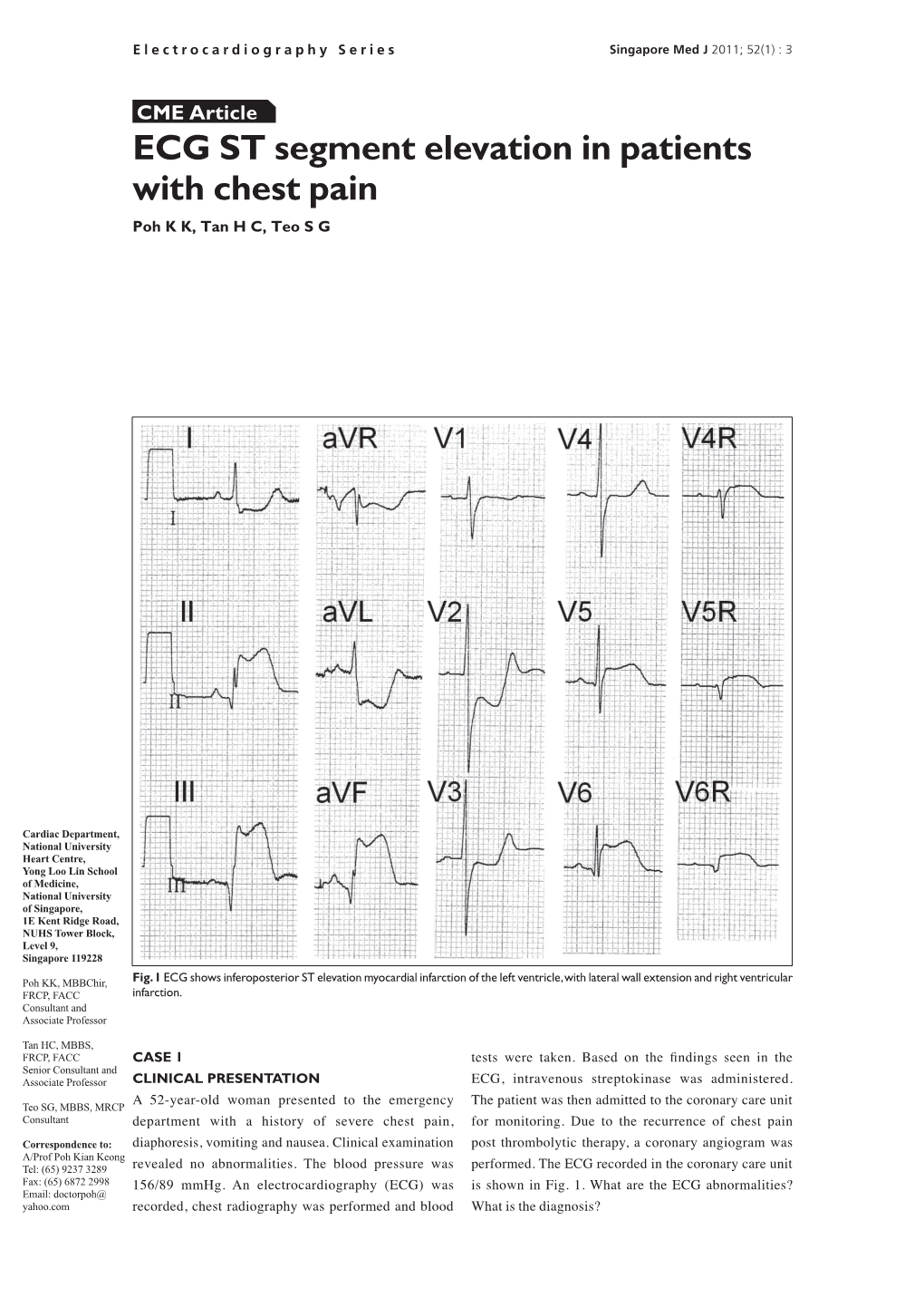 ECG ST Segment Elevation in Patients with Chest Pain Poh K K, Tan H C, Teo S G