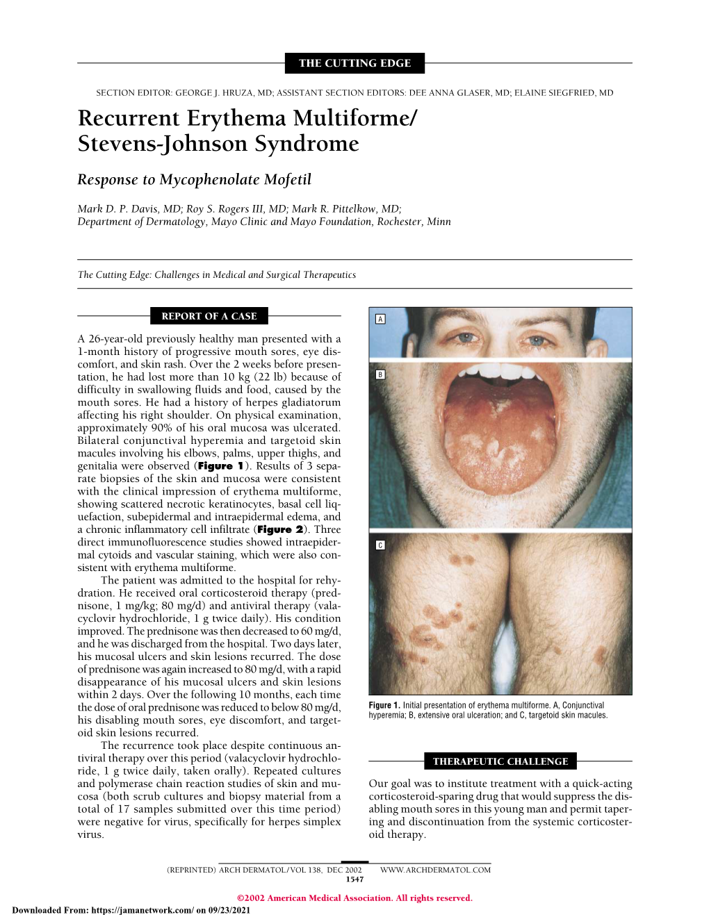 Recurrent Erythema Multiforme/ Stevens-Johnson Syndrome Response to Mycophenolate Mofetil